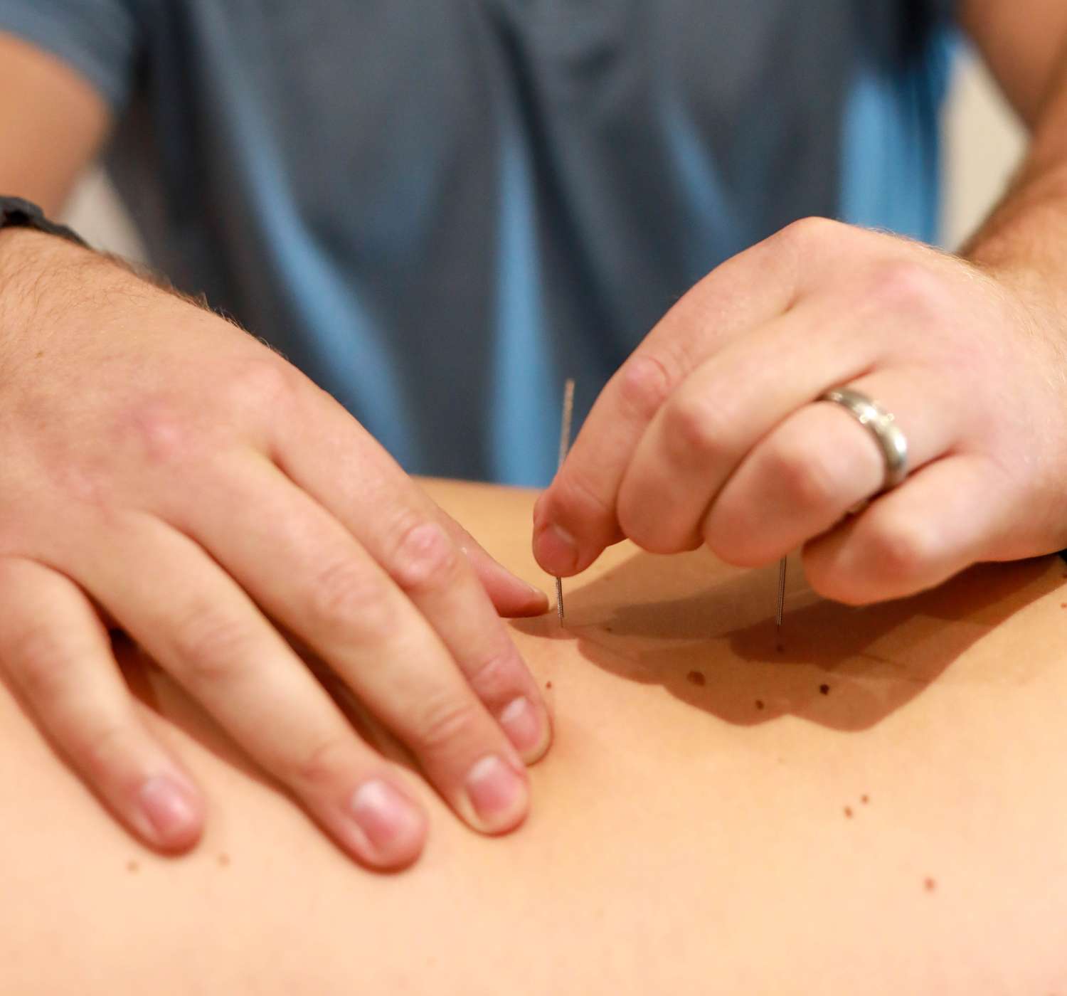 Close-up of a dry needling treatment on a patient's hand